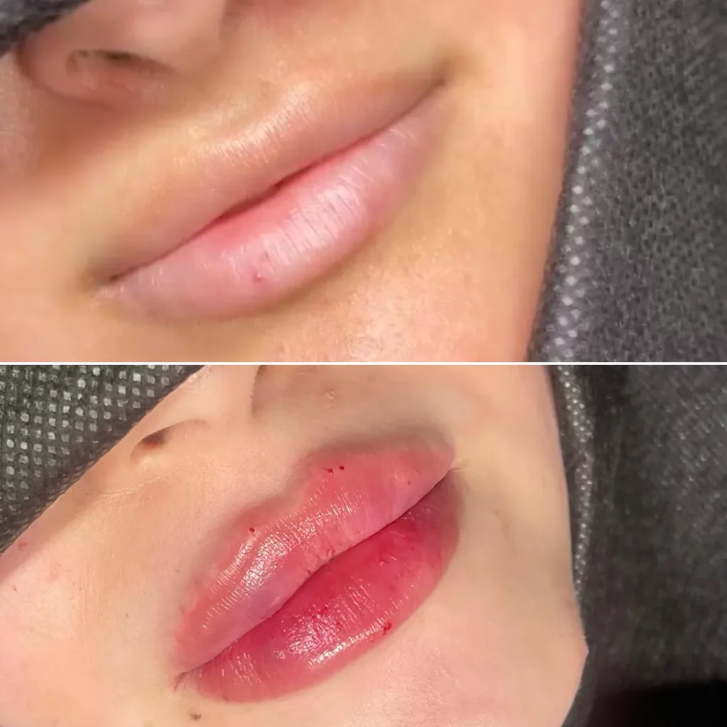 Lip Fillers in Decatur